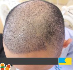 -大麦微针植发丨全国连锁