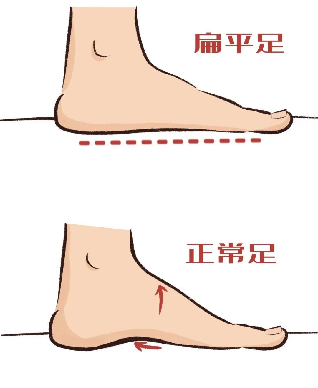什么是扁平足