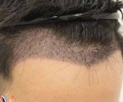 -大麦微针植发丨全国连锁