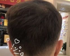 -大麦微针植发全国连锁