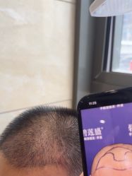 -碧莲盛·不剃发植发