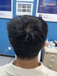 -大麦微针植发全国连锁