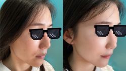 体验前-杭州米兰柏羽医疗美容医院