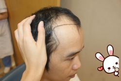 -大麦微针植发丨全国连锁