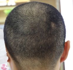 -大麦微针植发丨全国连锁