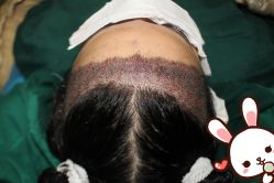 -大麦微针植发丨全国连锁