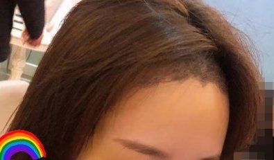 -大麦微针植发丨全国连锁