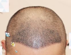 -大麦微针植发全国连锁