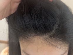 -碧莲盛·不剃发植发
