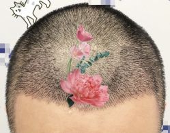 -大麦微针植发全国连锁