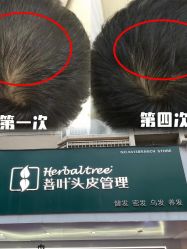 -菩叶脱发白发中心