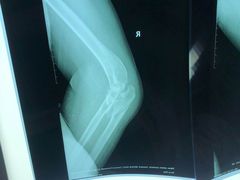 -大韩庄韩氏祖传正骨