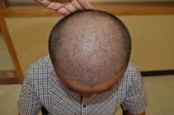 -大麦微针植发丨全国连锁