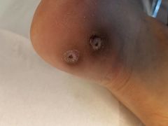 -世龙世家灰指甲鸡眼脚气甲沟炎跖疣护理(通州店)