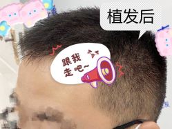 -大麦微针植发全国连锁