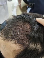 -碧莲盛·不剃发植发