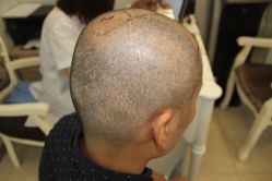 -大麦微针植发丨全国连锁