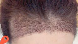 -大麦微针植发丨全国连锁