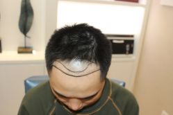 -大麦微针植发丨全国连锁