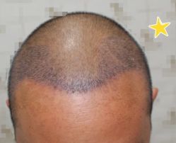 -大麦微针植发丨全国连锁