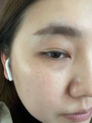 体验前-郡艺医疗美容·微整·眼鼻吸脂