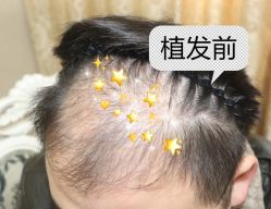 -大麦微针植发全国连锁