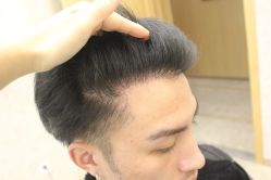 点击看大图 -大麦微针植发丨全国连锁