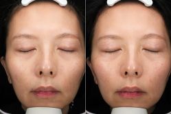 体验后-深圳芙必优医疗美容·抗衰中心