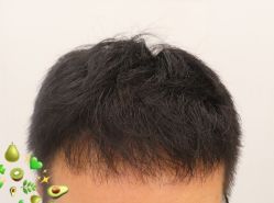 -大麦微针植发全国连锁