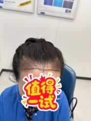 -大麦微针植发全国连锁
