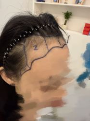 -大麦微针植发全国连锁