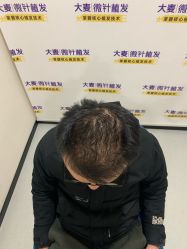 -大麦微针植发全国连锁