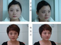 衡阳瘦脸针效果-新雅韩整形美容医院