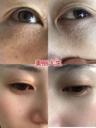-爱莎扁平疣·汗管瘤·斑痣中心