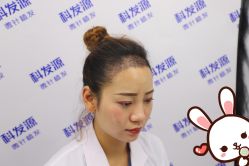 -大麦微针植发丨全国连锁