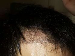 -大麦微针植发全国连锁