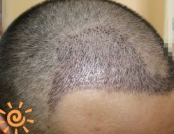 -大麦微针植发丨全国连锁