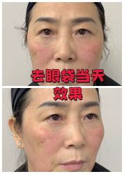 -广州健丽·去眼袋医疗美容机构