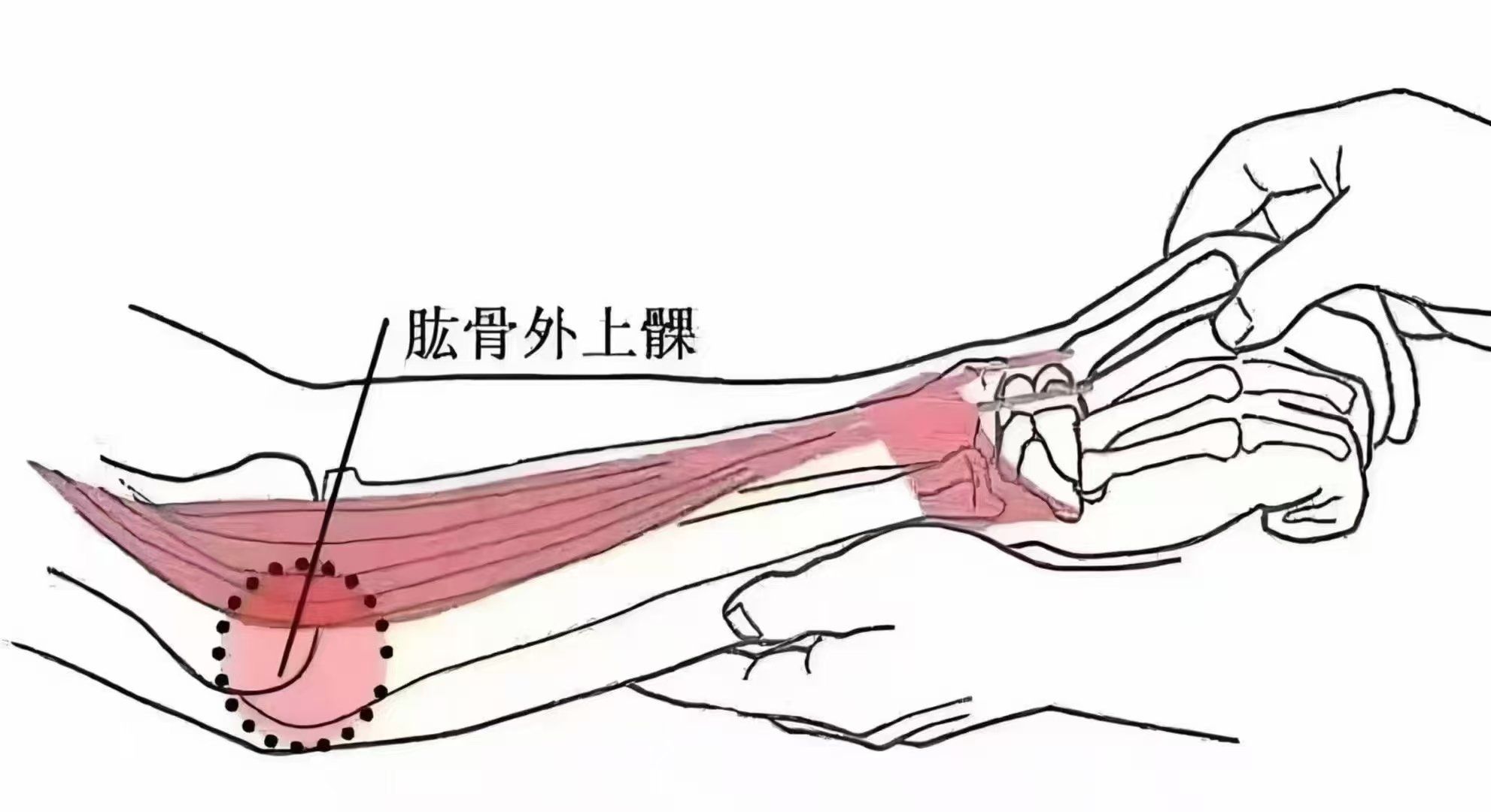 网球肘‮称又‬肱骨外‮髁上