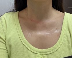 体验后-深圳米兰柏羽医疗美容医院