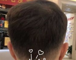 -大麦微针植发全国连锁