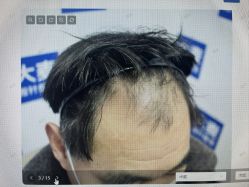 体验前-大麦微针植发丨全国连锁