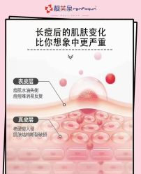 -靓芙泉专研痘痘肌