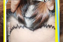 -大麦微针植发全国连锁