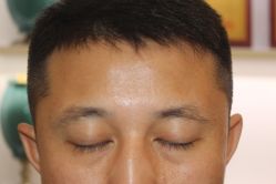 -大麦微针植发丨全国连锁