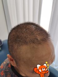 -大麦微针植发丨全国连锁