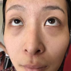 -美丽人生祛斑扁平疣汗管瘤中心