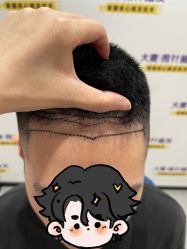 -大麦微针植发全国连锁