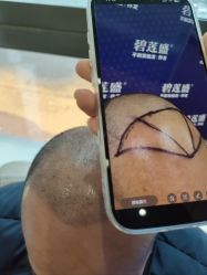 -碧莲盛·不剃发植发