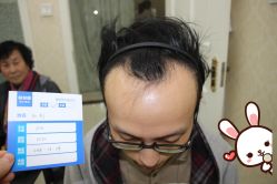 -大麦微针植发丨全国连锁